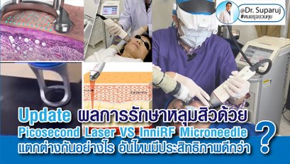 Update ผลการรักษาหลุมสิวด้วย Picosecond Laser VS InfiniRF Microneedle แตกต่างกันอย่างไร อันไหนมีประสิทธิภาพดีกว่า ?